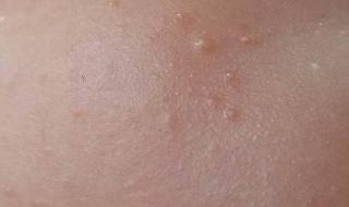 脸上长小疙瘩怎么办 脸上长小疙瘩怎么办